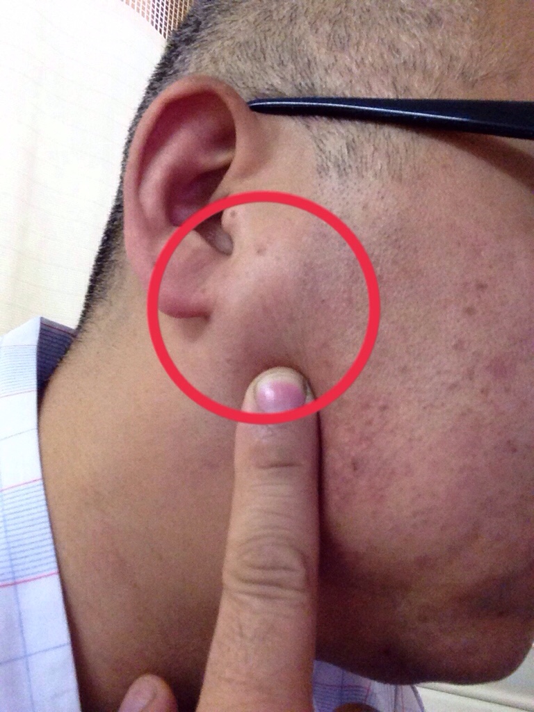 腫瘍 腺 耳 下